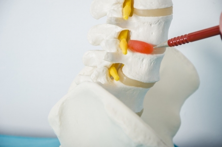 WHAT IS A HERNIATED DISC?