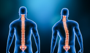 Demystifying scoliosis - what is it and why does it matter?