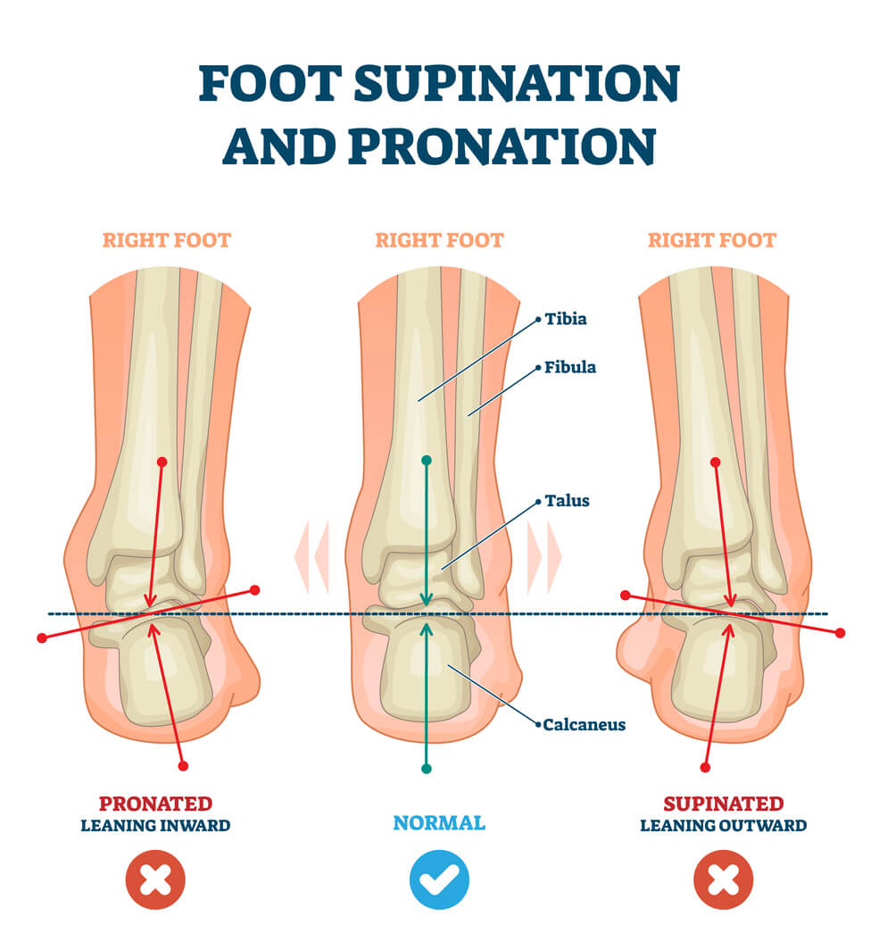 <div>Are you ‘out of step’? Understanding over pronation and its impact on your body</div>