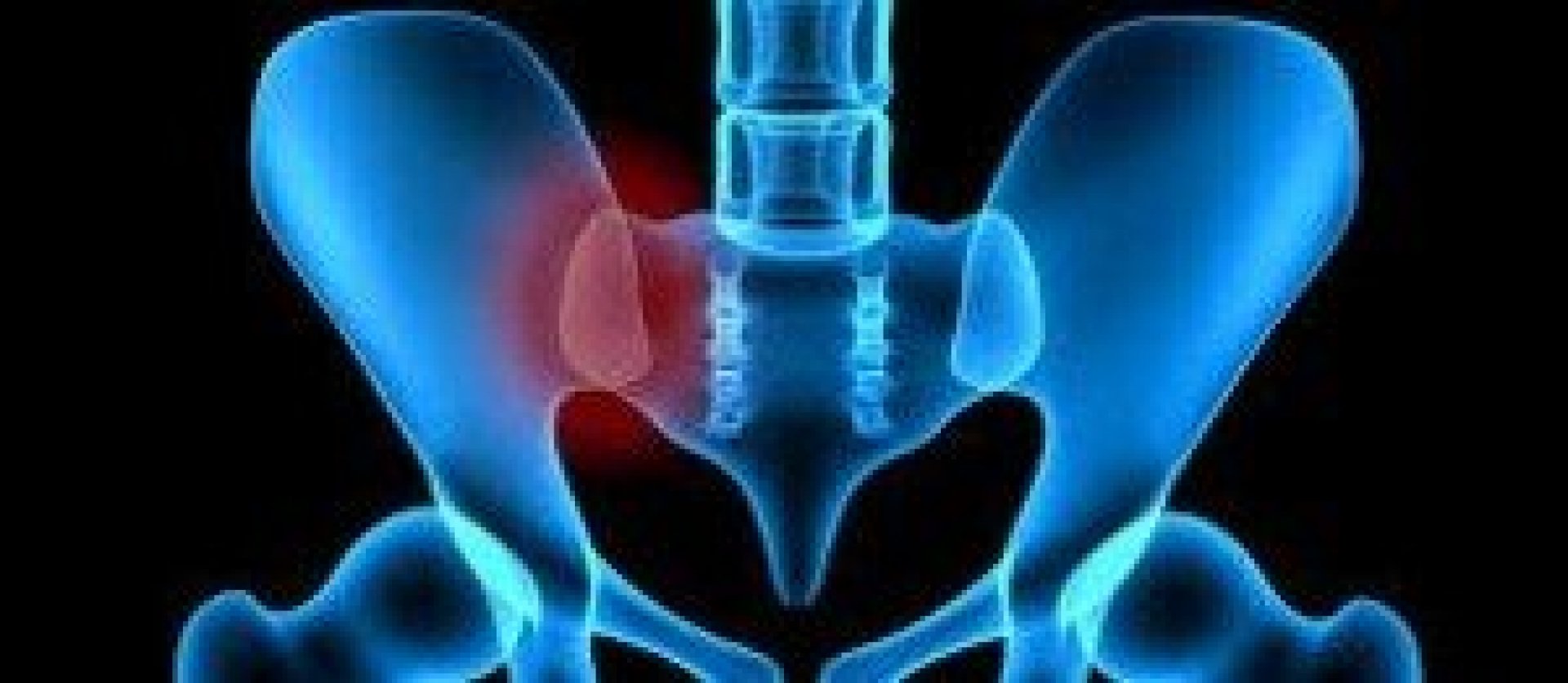 Sacroiliac Joint Syndrome a common cause of back pain