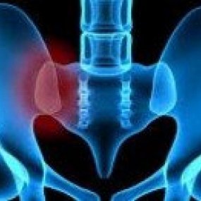 Sacroiliac Joint Syndrome a common cause of back pain image